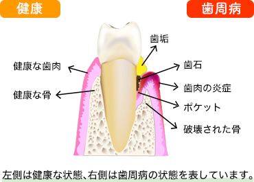 歯周病ってどんな病気